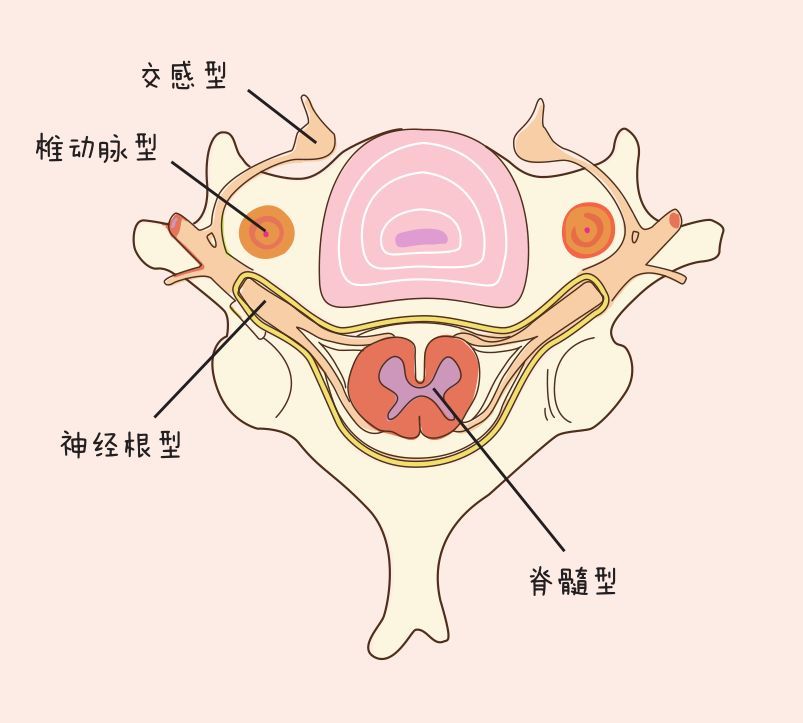 动静健康 对照5张图,弄清颈椎病