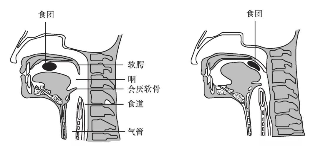 动静健康|吞咽动作不简单,别把"吞咽困难"不当回事