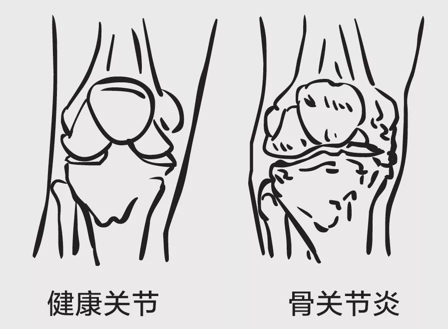 动静健康|如何才能把骨刺消掉?