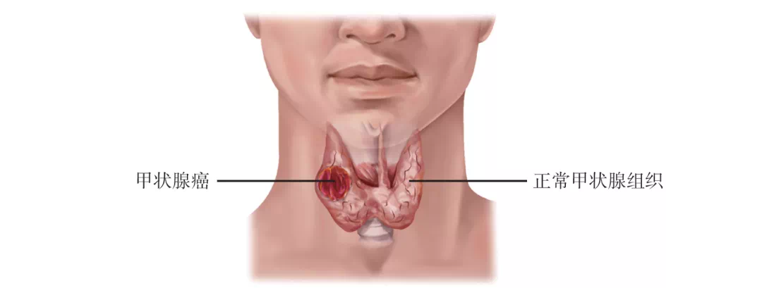 动静健康 身体出现哪些症状时,应该警惕得了甲状腺癌?