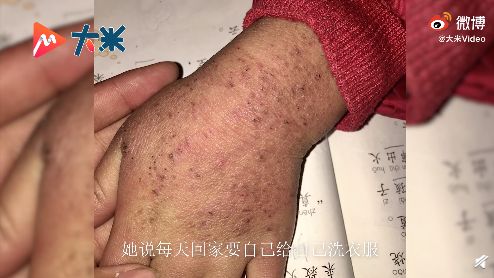 一所乡村小学实习,这两天,她发现班上一名留守女孩双手冻伤皴裂严重