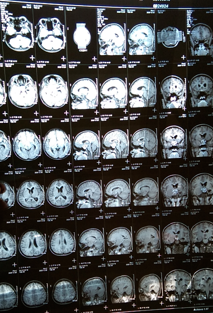 脑瘤报告单图片图片