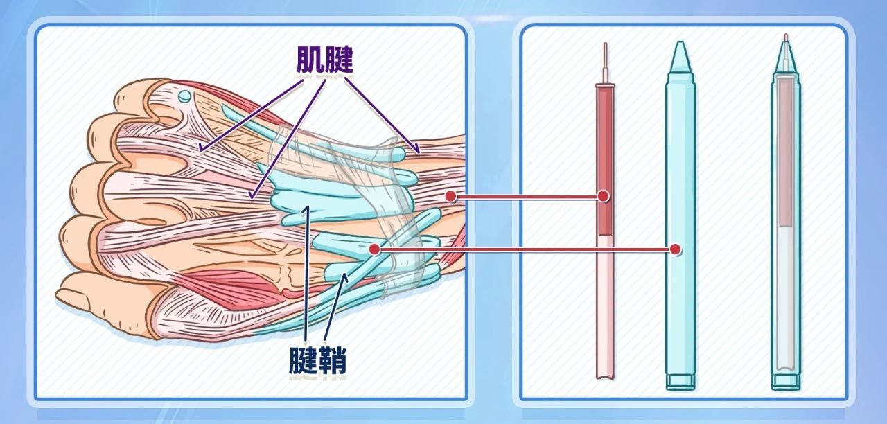 腱鞘的主要作用是让肌腱更好地发挥力学功能,如果将肌腱比作笔芯,腱鞘