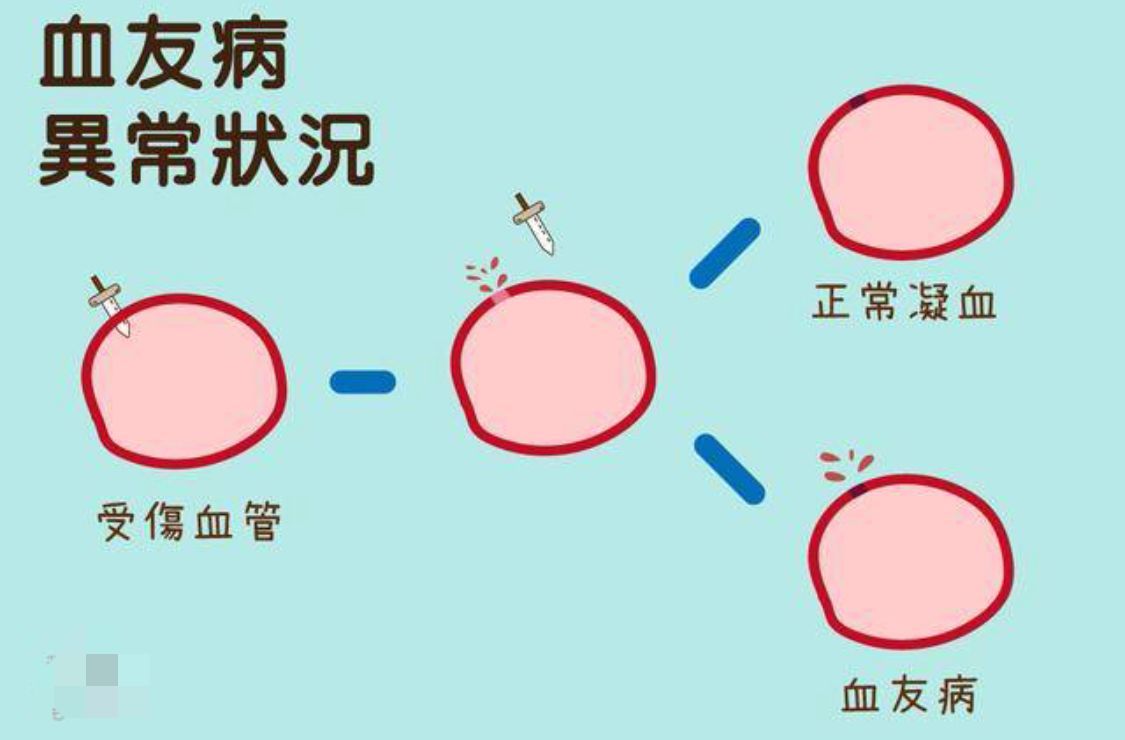 同在藍天下 | 血友病患兒預防治療越早越好